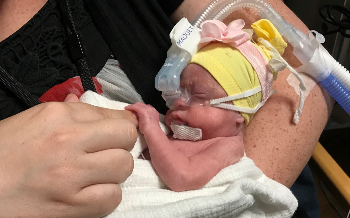 Preemie One Of The First To Receive Heart Device Amplatzer Piccolo